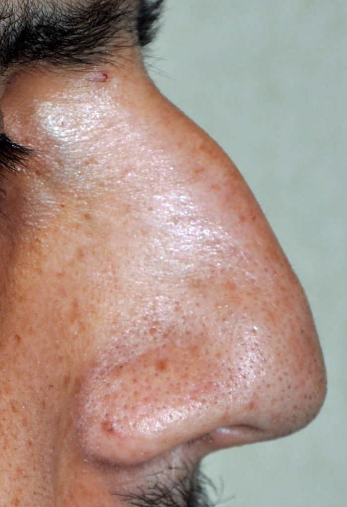 Basic Aesthetic and Surgical Concepts in Latino Rhinoplasty Explore