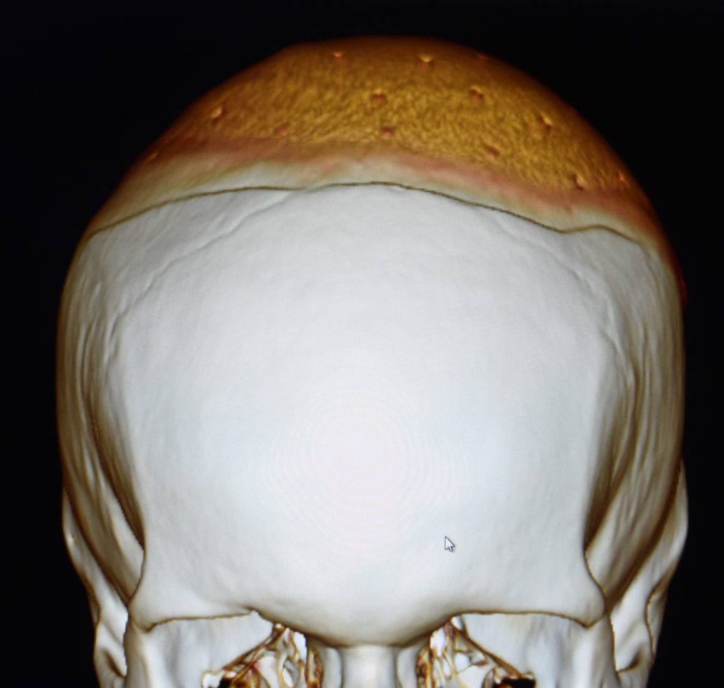 3d Ct Scan Assessment Of Custom Skull Implant Perfusion Holes Explore