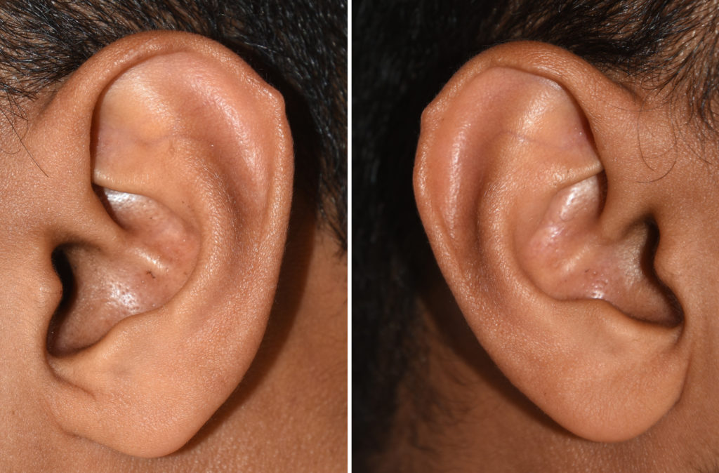 Plastic Surgery Case Study Excision of Darwin's Tubercles of the Ears