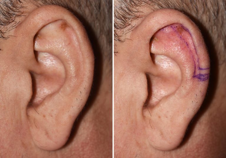 Eustachian tube dysfunction picture