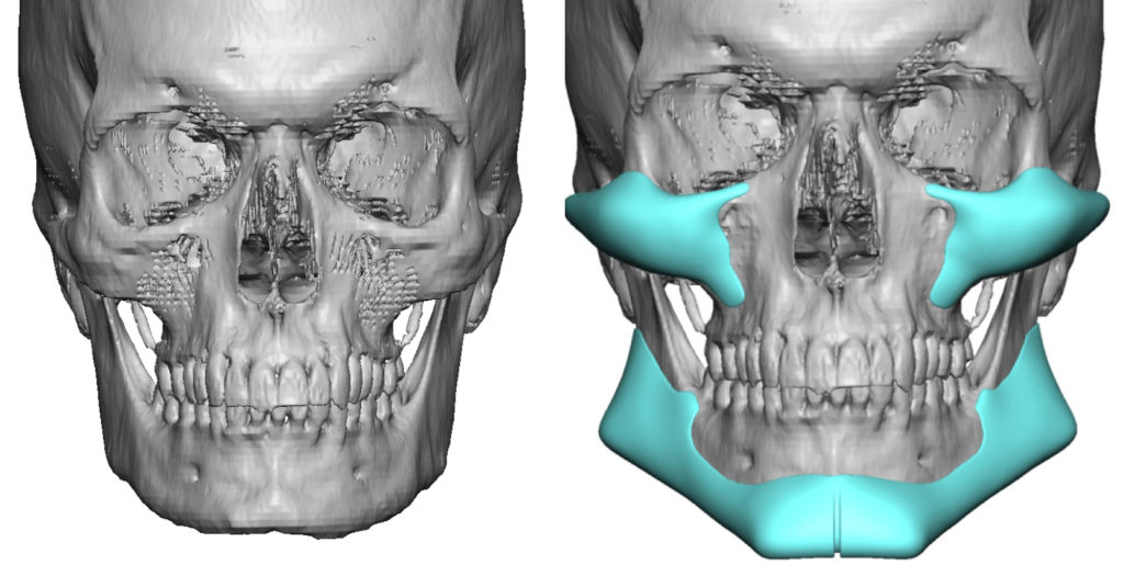 Plastic Surgery Case Study - Strong Male Facial Masculinization with ...