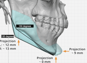 gonial angle