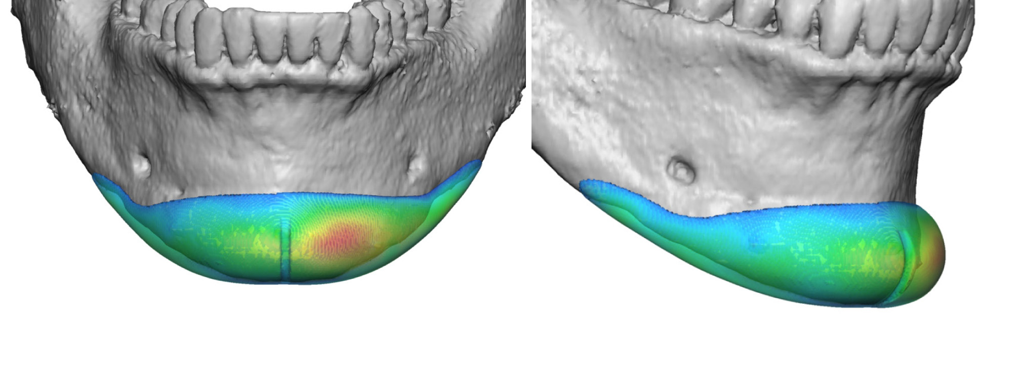 Plastic Surgery Case Study Custom Chin Implant for Secondary