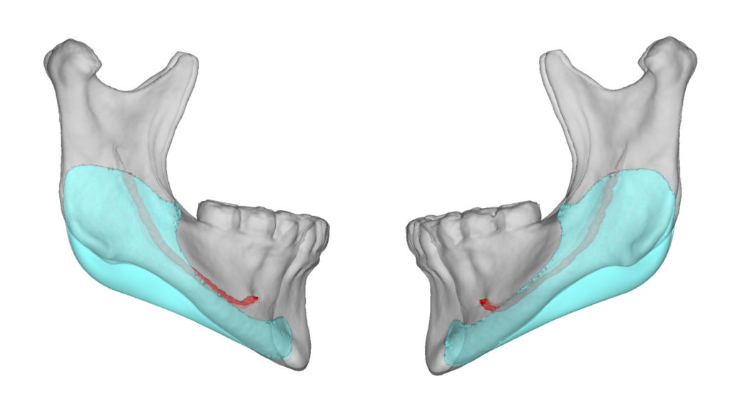 Plastic Surgery Case Study - Custom Jaw Angle Implants for Correction ...