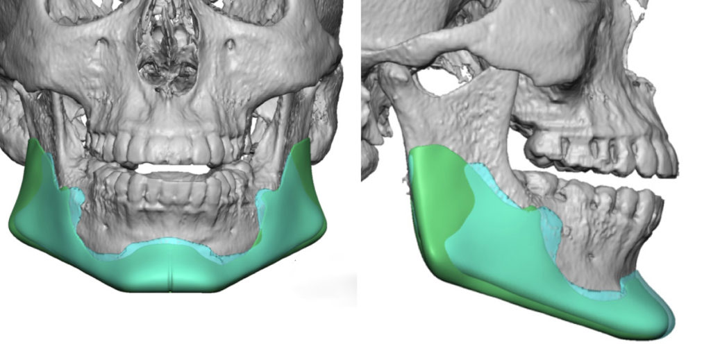 Plastic Surgery Case Study - Male Custom Jawline Implant Replacement ...