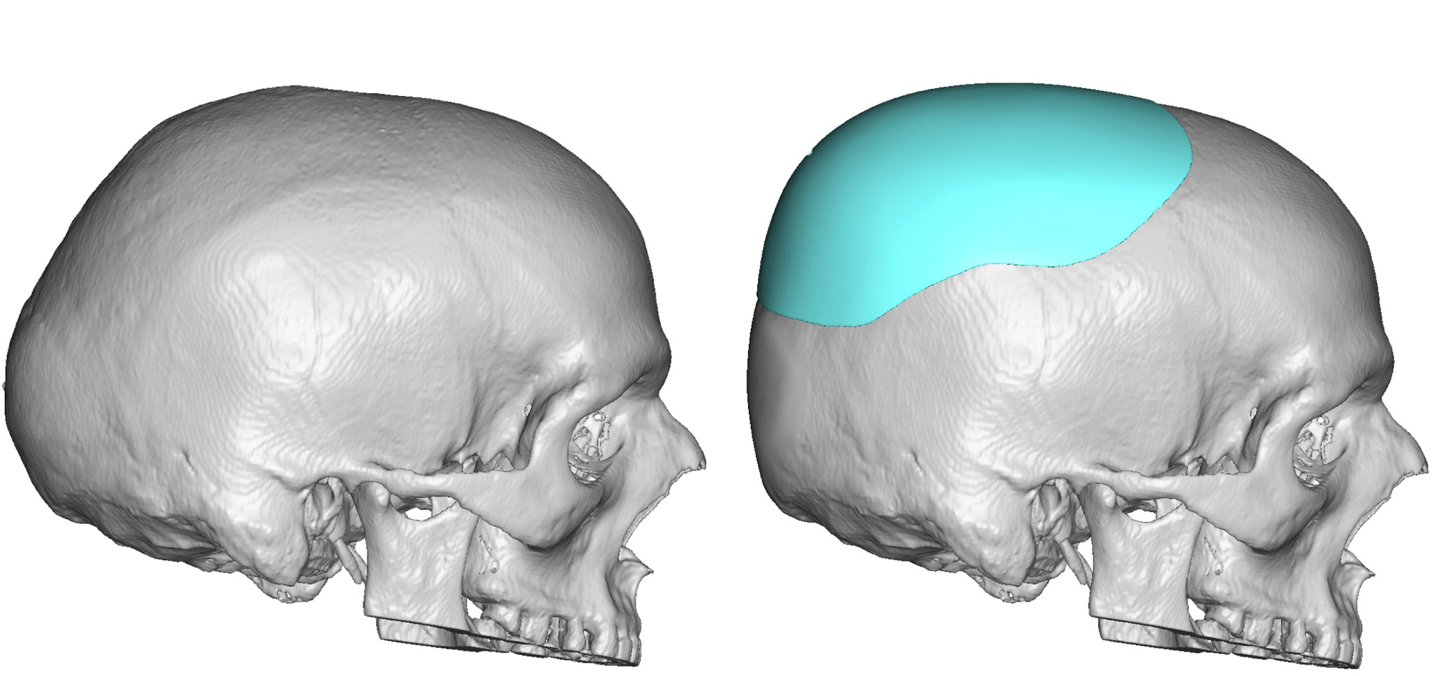 Custom Skull Implant With Occipital Skull Reduction Design Side View Dr