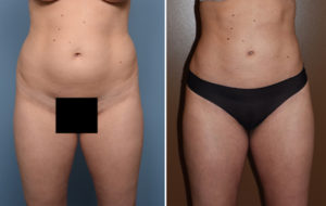 Abdominoplasty and Liposuction to Bilateral Flanks Case #37493 - The  Plastic Surgery Group