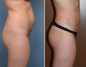 Liposuction Abdomen and Flanks Case 7001 - The Plastic Surgery Group