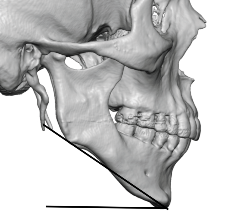 The Use Of Mandibular Plane and Gonial Angle Measurements in Custom ...