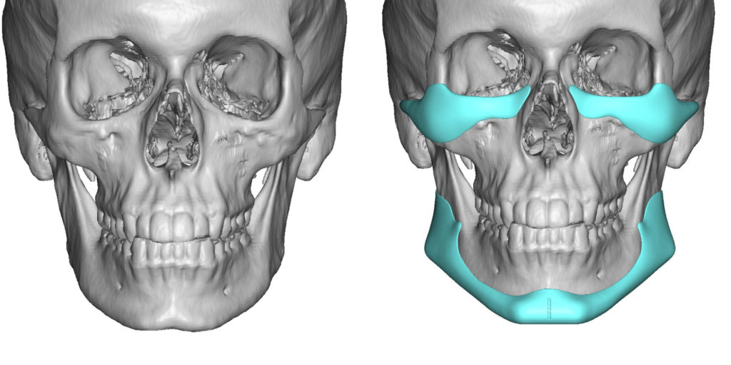 Plastic Surgery Case Study - Masculinizing the Soft Male Face with ...