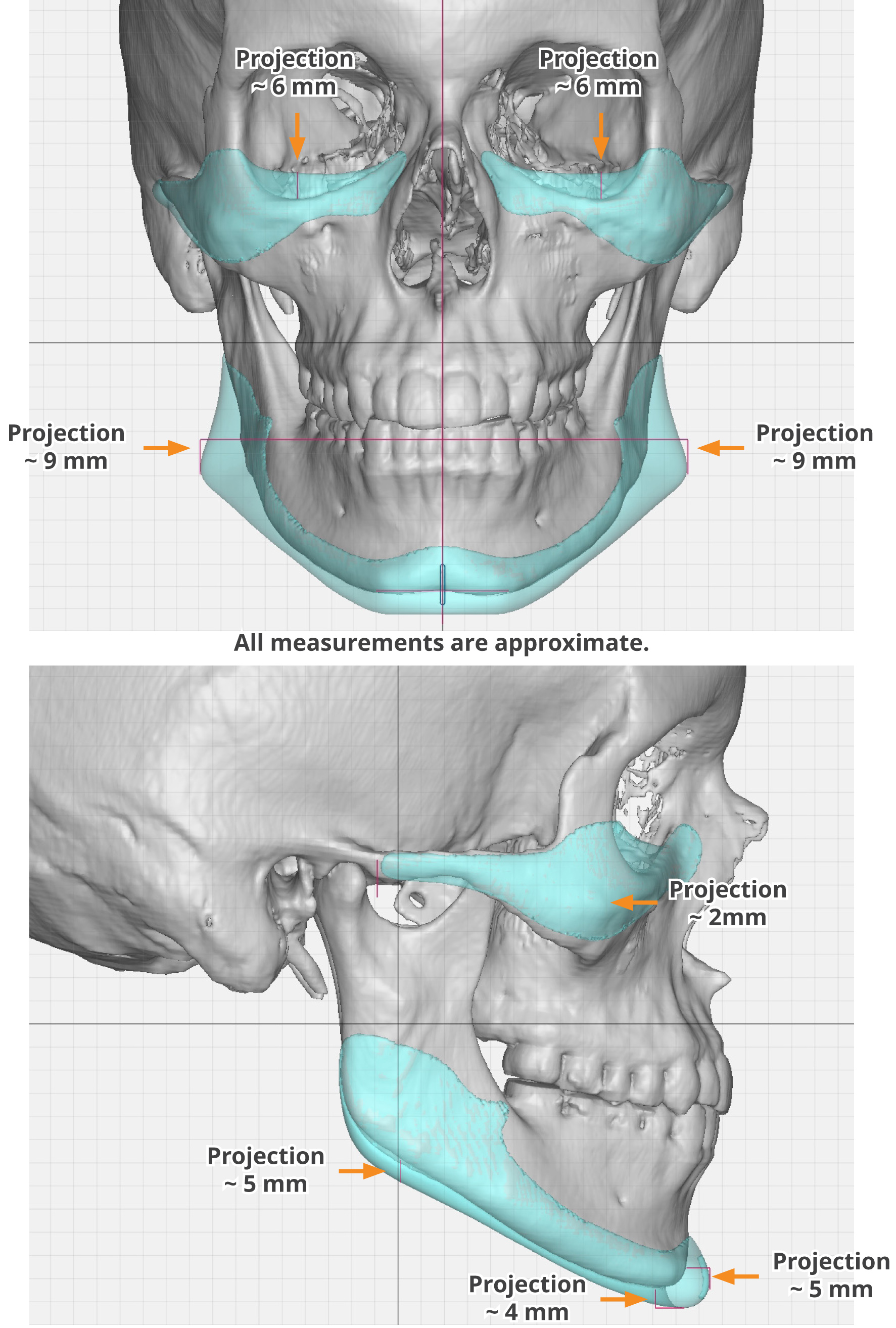 Male Masculinization Custom Facial Implant dimensions Dr Barry Eppley ...