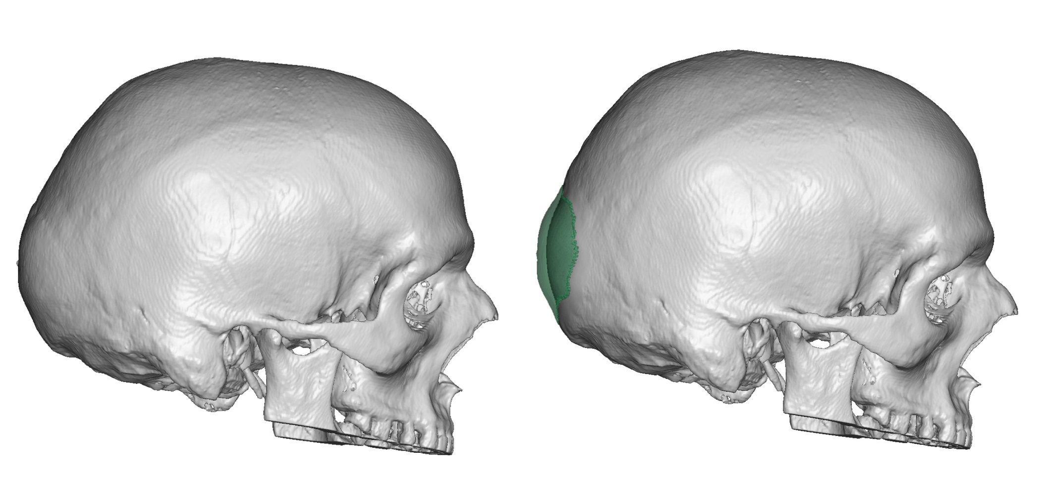 Occipital Skull Reduction Planning Side View Dr Barry Eppley