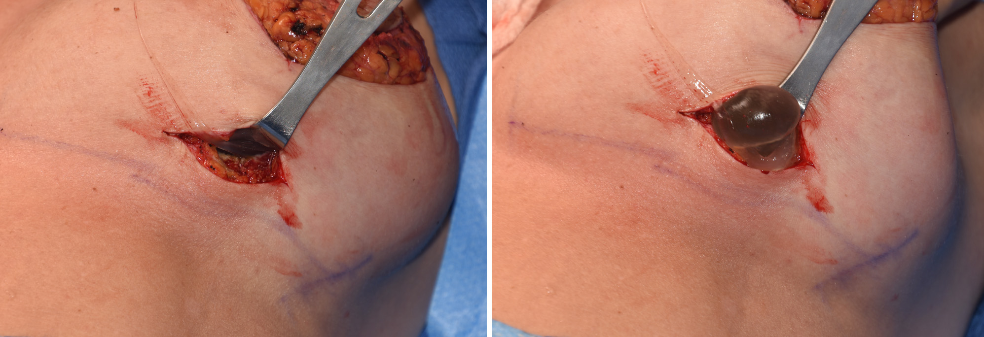 Safest breast implants 2021 picture