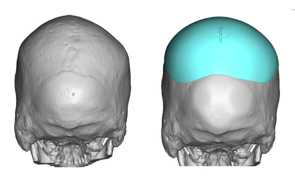 Plastic Surgery Case Study Skull Asymmetry Correction With Occipital