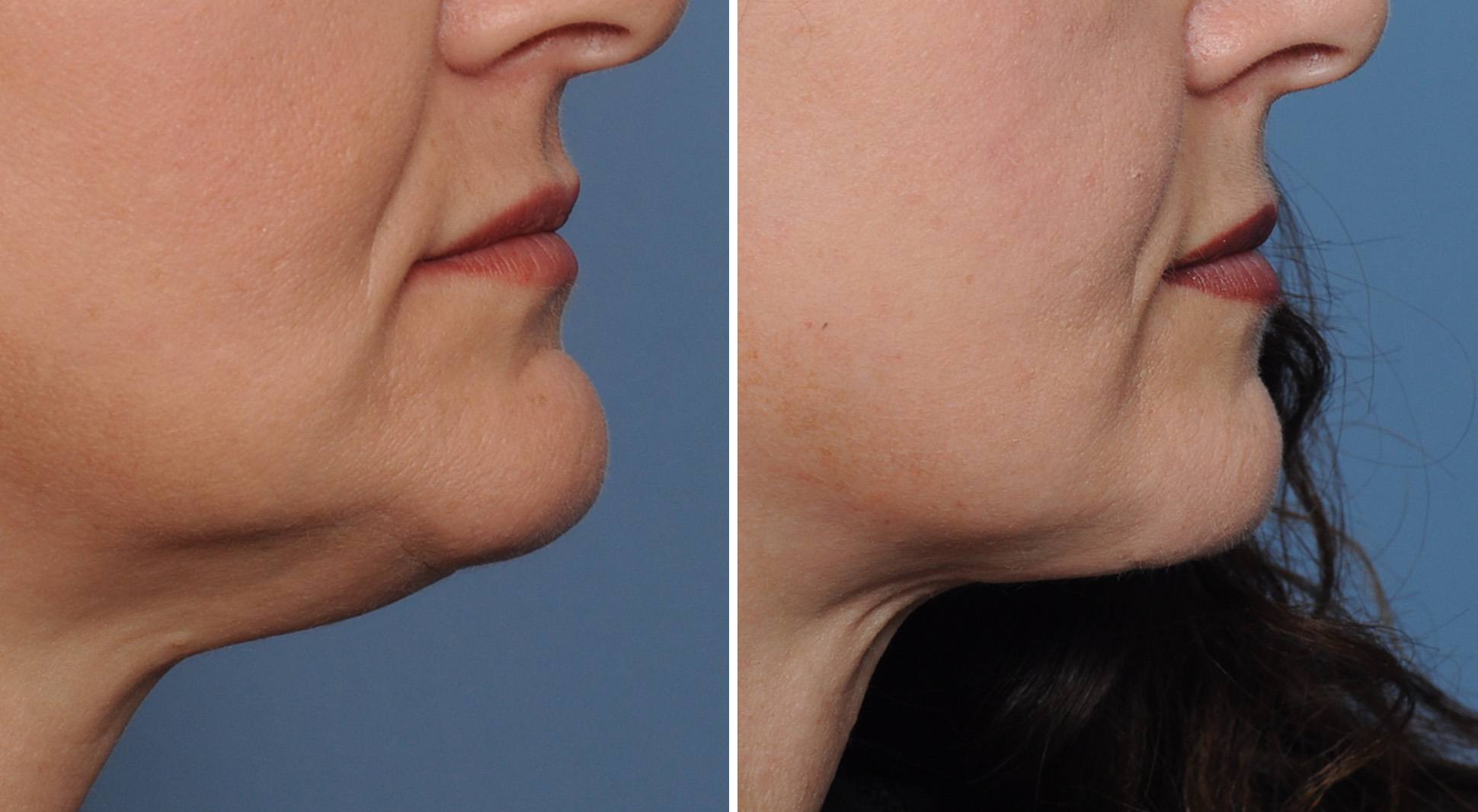 Plastic Surgery Case Study Submental Chin Reduction for the Ball