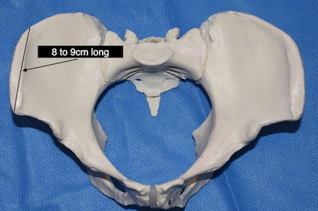 The Anatomy Basis of Aesthetic Iliac Crest Reduction - Explore Plastic  Surgery