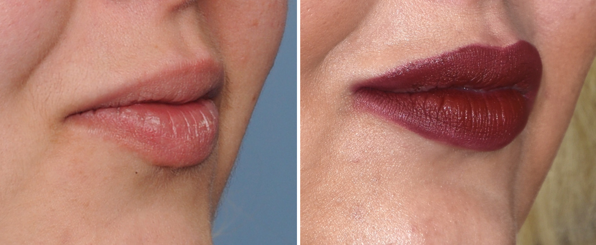 corner-of-mouth-lifts-withg-buccal-fat-lip-injections-oblique-nview-dr