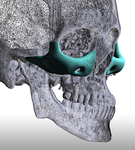 Plastic Surgery Case Study - Custom Infraorbital-Maxillary-Malar ...