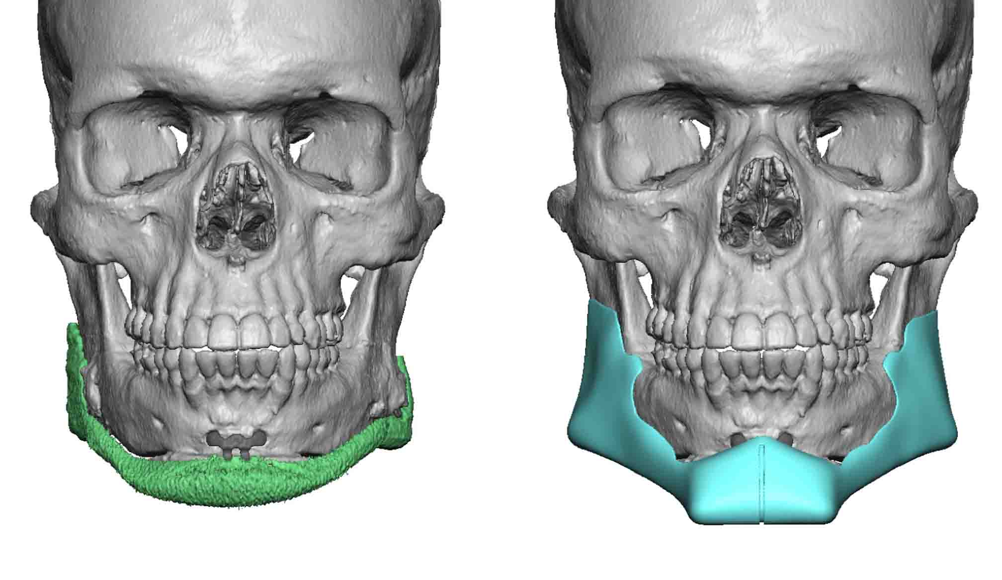 Plastic Surgery Case Study - Custom Jawline Implant Replacement ...