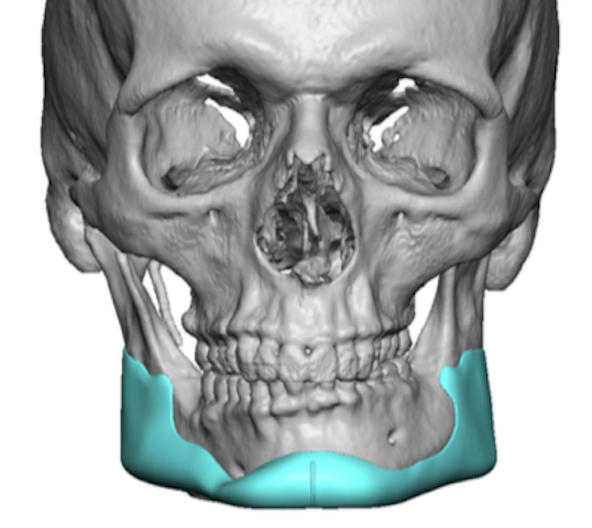 Custom Jawline Implant For Lower Jaw Asymmetry Front View Dr Barry 