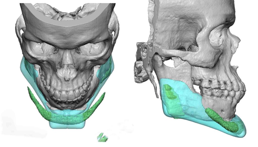 Plastic Surgery Case Study - Custom Jawline Implant Replacement ...