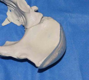 Iliac Crest Implants For Aesthetic Widening of the Bony Hips