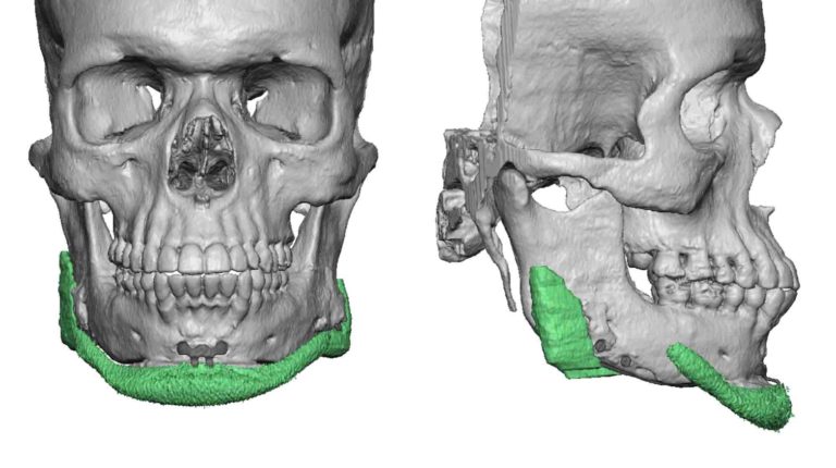 Inadequate Standard chin and jaw angle implants 3D CT scan front and ...