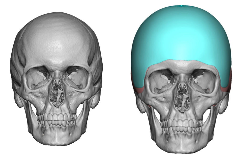 Plastic Surgery Case Study Two Piece Custom Skull Implant for