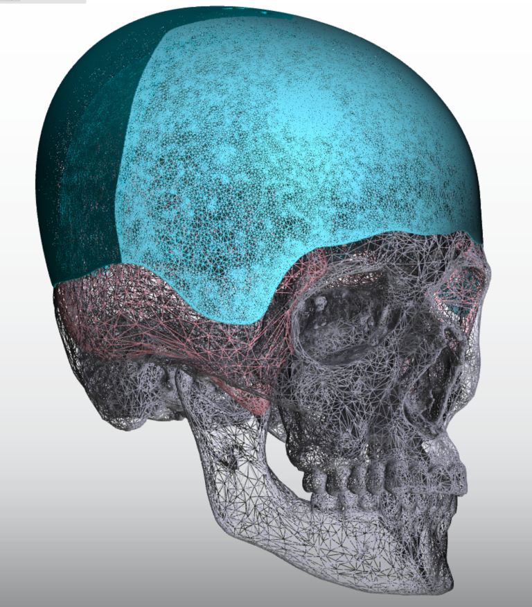 Large Two Piece Custom Skull Implant Oblique View For Small Male Head