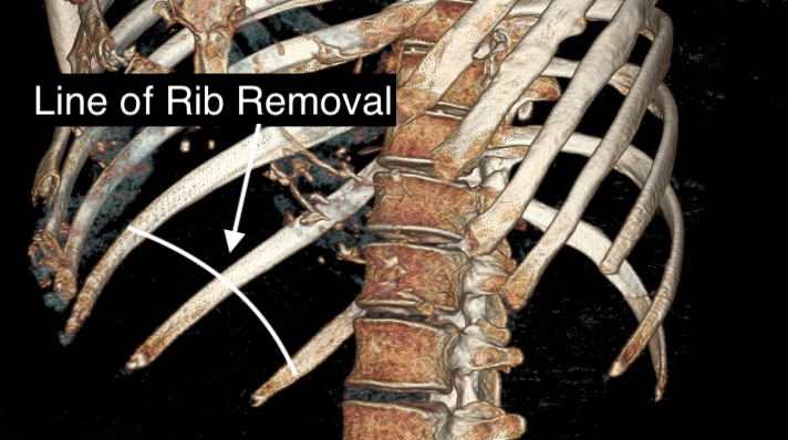 Rib Removal Anatomy Oblique View Dr Barry Eppley Indianapolis Explore
