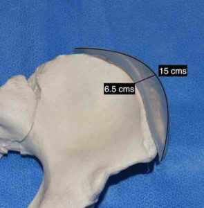 Iliac Crest Implants For Aesthetic Widening of the Bony Hips - Explore
