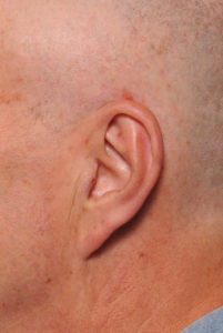 bald headed neck scar