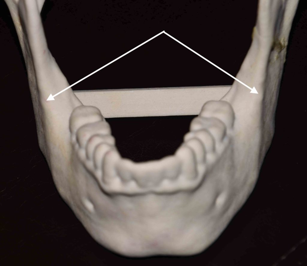 The Aesthetic Relevance of the Anterior Ramus Line in Custom Jawline