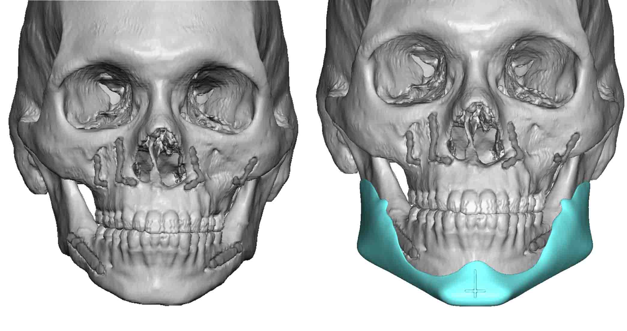 Custom Jawline Implant After Orthognathic Surgery Design Front View Dr 