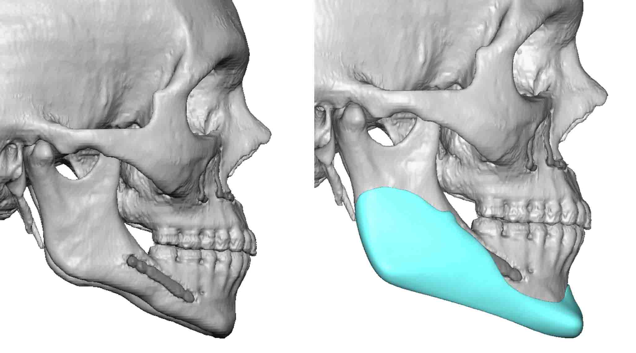 Custom Jawline Implant after Orthognathic Surgery design side view Dr ...