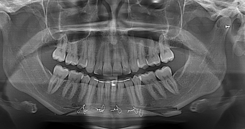 Plastic Surgery Case Study - Bilateral Inferior Border Shaves and Chin ...