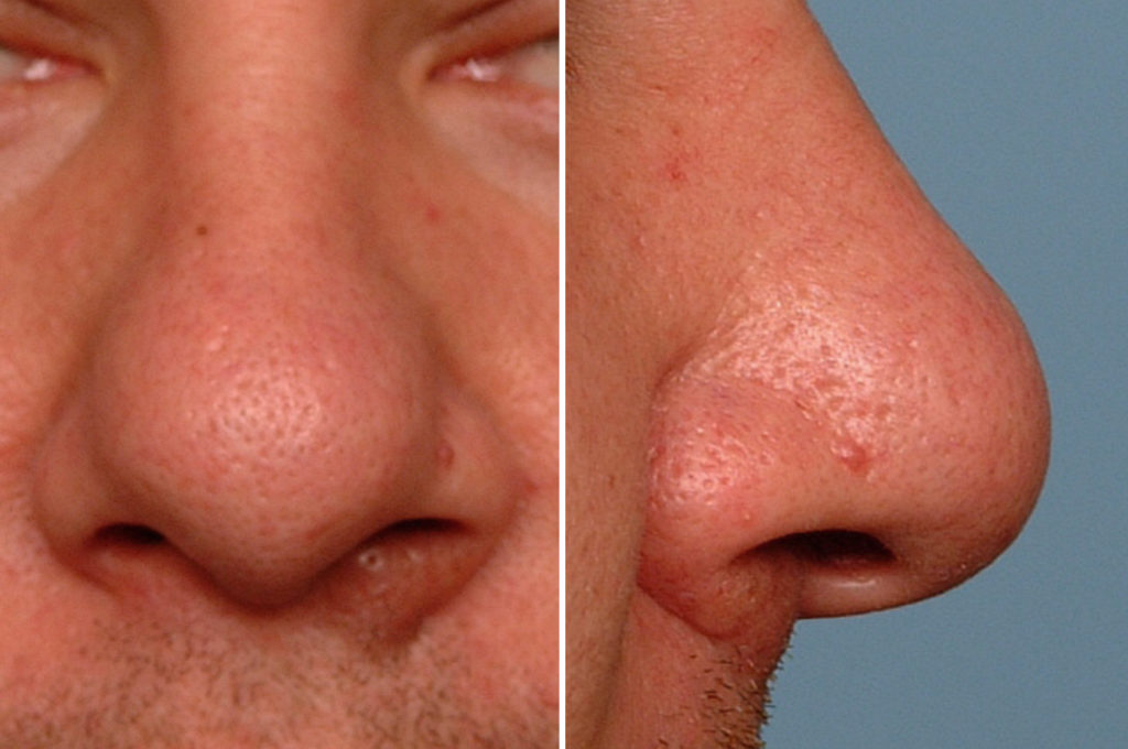 Bulbous Nasal Tip Cartilage Outlines Dr Barry Eppley Indianapolis