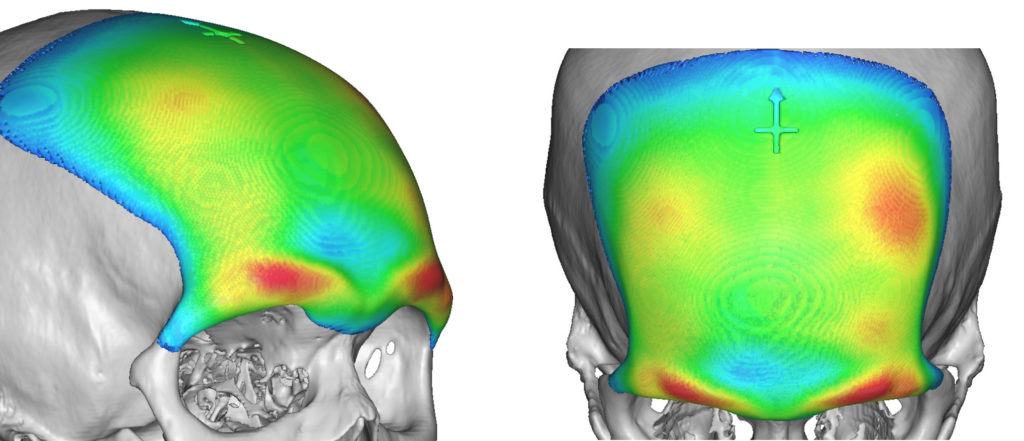 plastic-surgery-case-study-the-design-and-placement-of-the-custom