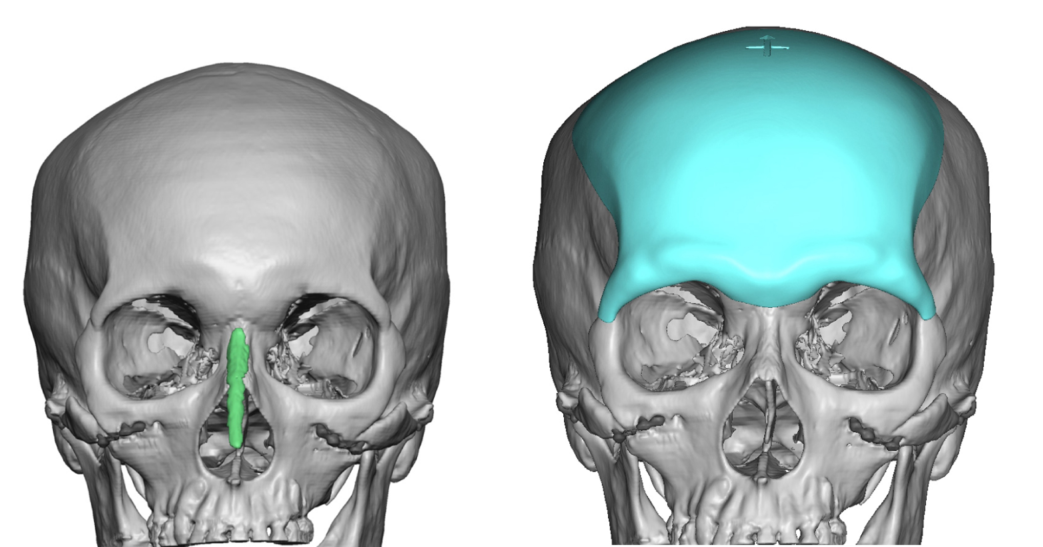 Plastic Surgery Case Study The Design and Placement of the Custom