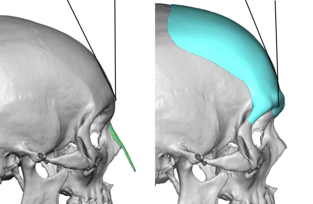 Plastic Surgery Case Study The Design and Placement of the Custom