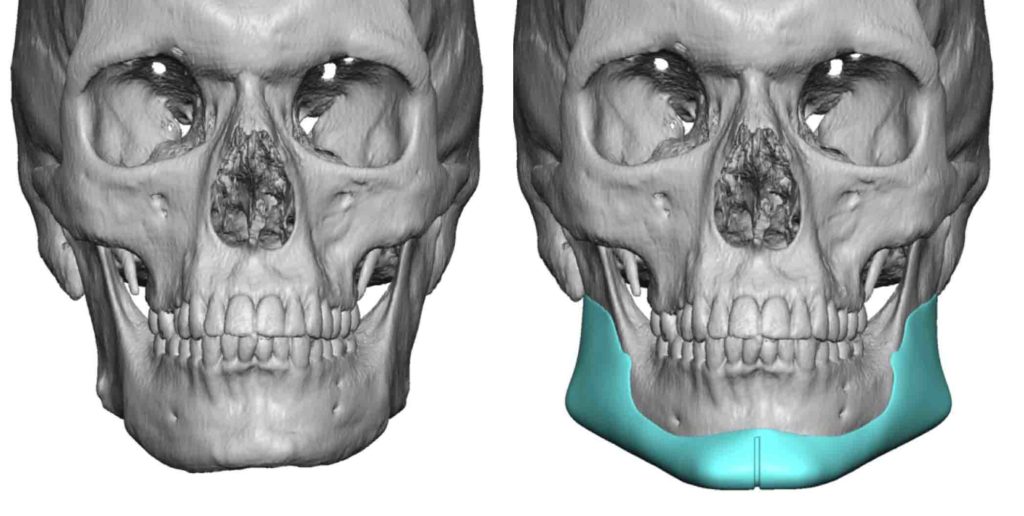 Custom Jawline Implamnt Design In Jaw Asymmetry Front View Dr Barry