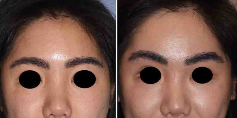 Plastic Surgery Case Study Total Forehead Reshaping With A Custom