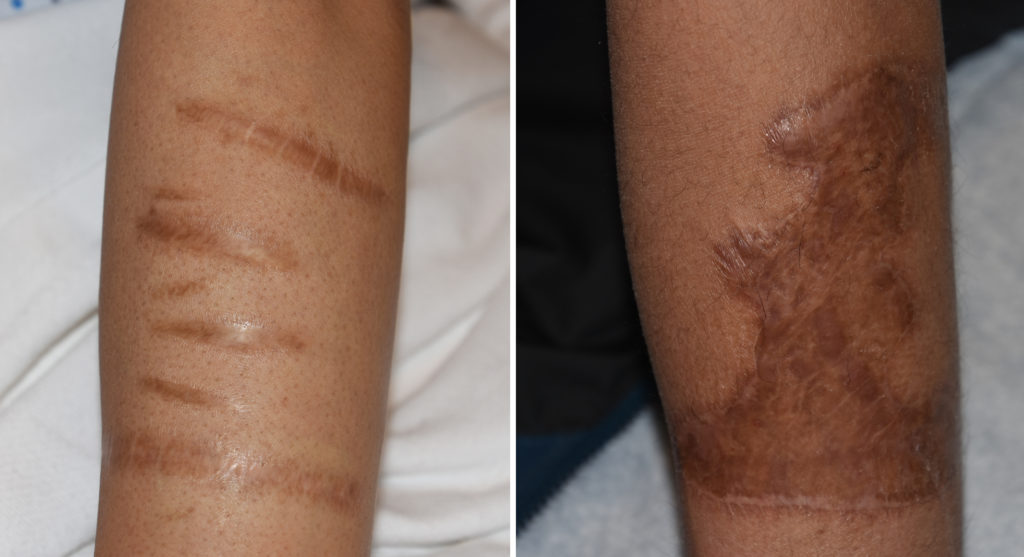 Forearm Scar Excision And Skin Graft Results Dr Barry Eppley Indianapolis Explore Plastic Surgery