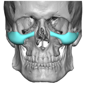 Male High Cheekbone Look Implant style frnt view 3D CT scan Dr Barry ...