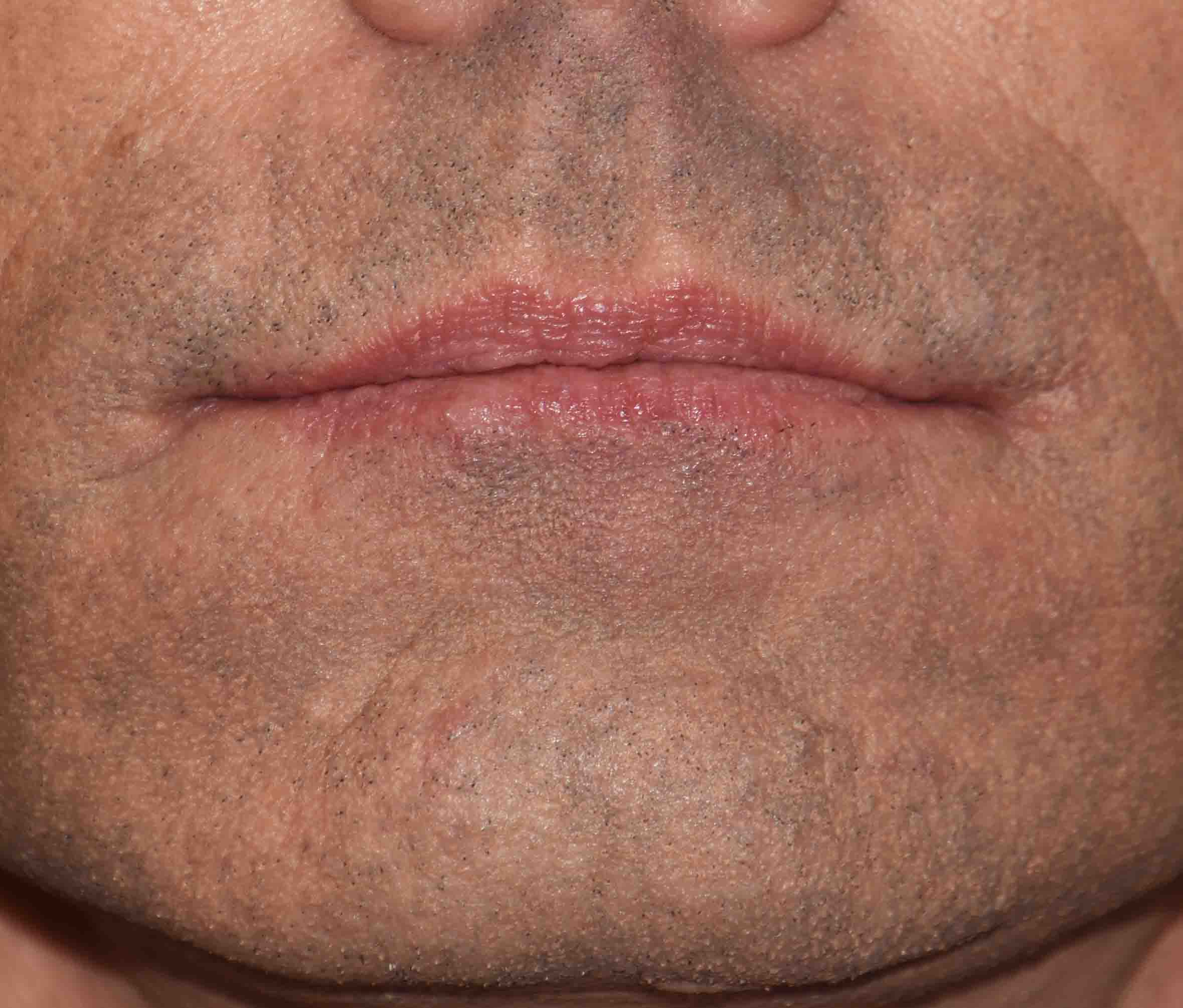 Pennant Corner of Mouth Lift results Dr Barry Eppley Indianapolis