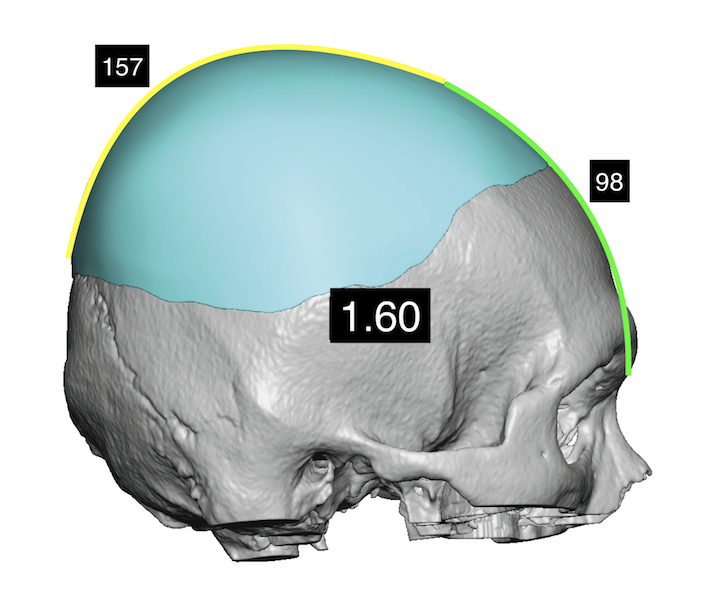 Aesthetic Skull Reshaping