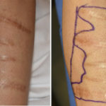 scar revision Archives - Explore Plastic Surgery