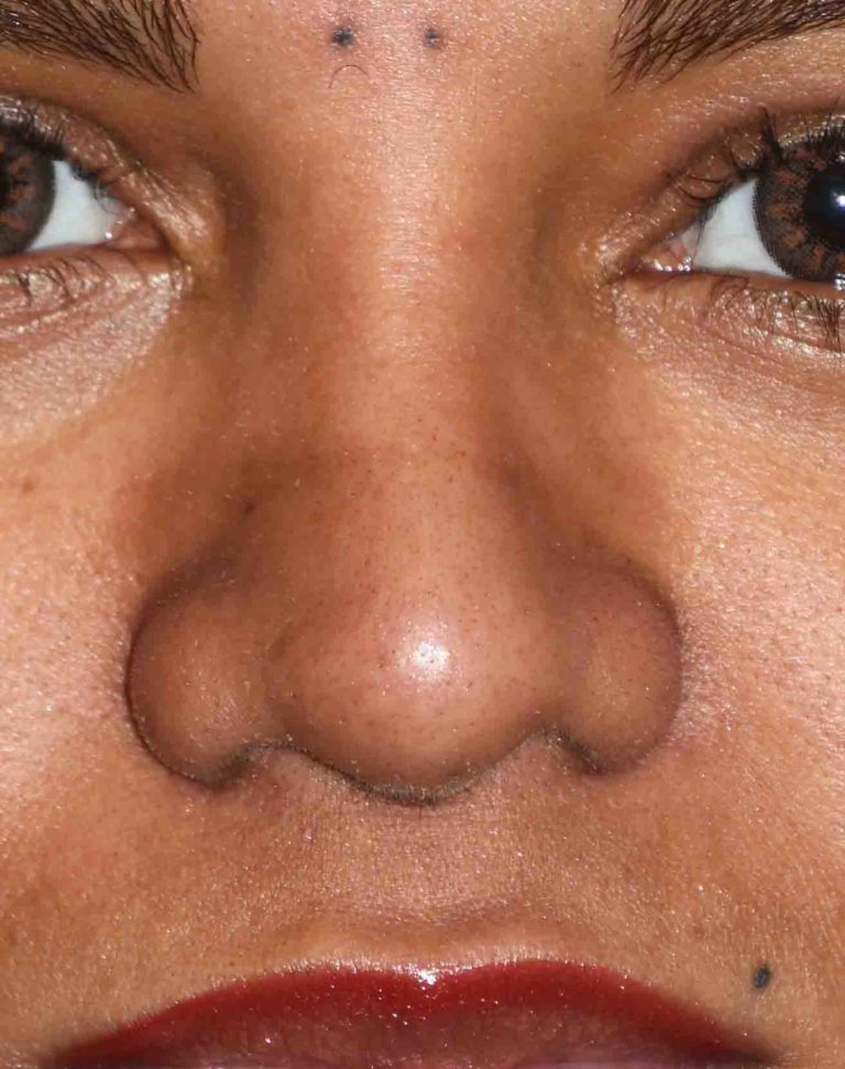 female-bulbous-nose-rhinoplasty-front-after-dr-barry-eppley