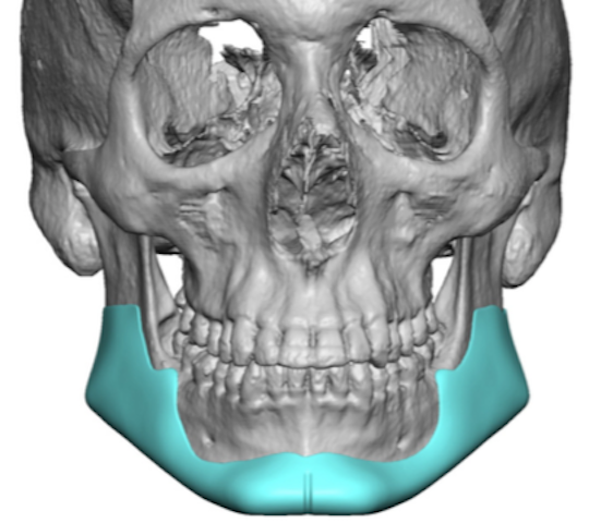 Facial Masculinization Surgery - Lower Third Reshaping - Chin and ...