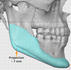 The Anatomy of Masseteric Muscle Dehiscence vs Implant Reveal In Jaw ...